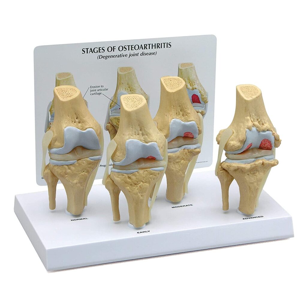 Modular Knee Model Knee Arthritis Model (Osteoarthritis - Knee Disease Model) - Models Cart