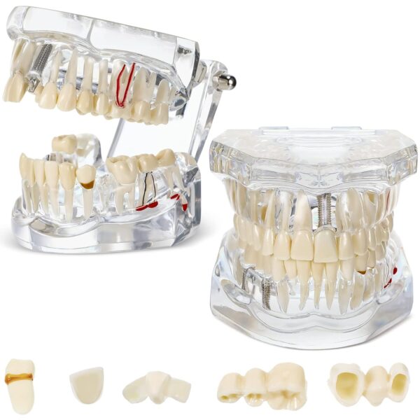 Transparent Dental Model with pathologies, cavities and treatments