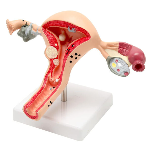 Uterus and Ovary Anatomy Model With Common Pathologies