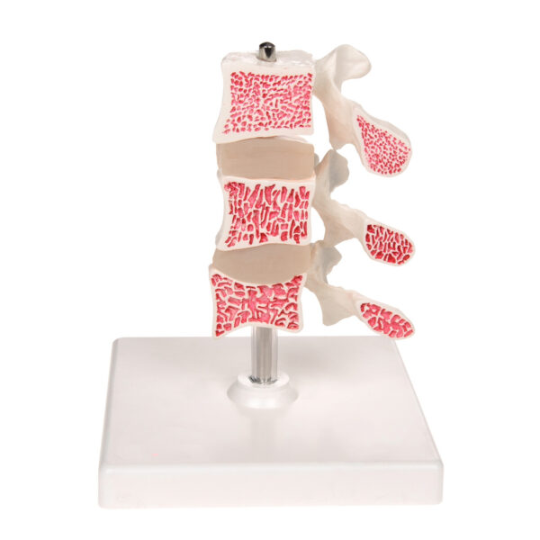 Cutaway Osteoporosis Model