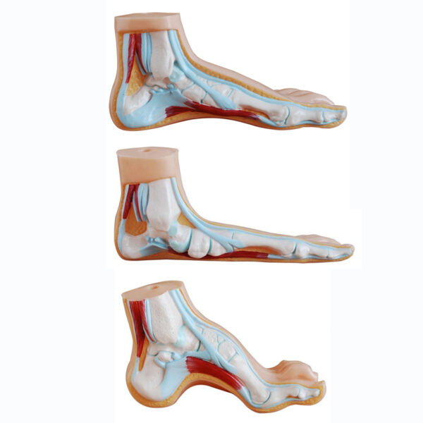 Normal, Flat, Arched Foot Model